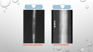Lack of root penetration Lack of root fusion
 