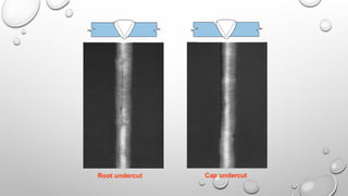 Cap undercut
Root undercut
 