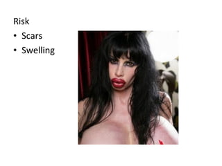 Risk
• Scars
• Swelling
 