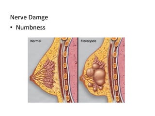 Nerve Damge
• Numbness
 
