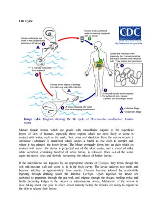Life Cycle
Image 1-16. Diagram showing the life cycle of Dracunculus medinensis, Guinea
worm.
Mature female worms which are gravid with microfilariae migrate to the superficial
layers of skin of humans, especially those regions which are most likely to come in
contact with water, such as the ankle, foot, arms and shoulders. Here the worms secrete a
substance (substance is unknown) which causes a blister to rise over its anterior end
where it has pierced the lower layers. The blister eventually forms into an ulcer which on
contact with water, the uterus is projected out of the ulcer cavity, and a cloud of milky
white secretion, containing hundred of active larvae, is released. Once out of the water
again the uterus dries and shrivels preventing the release of further larvae.
If the microfilariae are ingested by an appropriate species of Cyclops, they break though the
soft mid-intestine wall and come to lie in the body cavity. The larvae undergo two molts and
become infective in approximately three weeks. Humans become infected by accidentally
ingesting through drinking water the infective Cyclops. Upon ingestion the larvae are
activated to penetrate through the gut wall, and migrate through the tissues, molting twice and
finally becoming lodges in the viscera or subcutaneous tissues. Maturation of the worms is
slow taking about one year to reach sexual maturity before the females are ready to migrate to
the skin to release their larvae.