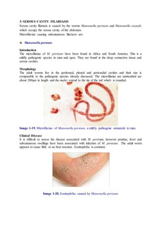 3- SEROUS CAVITY FILARIASIS
Serous cavity filariasis is caused by the worms Mansonella perstans and Mansonella ozzardi,
which occupy the serous cavity of the abdomen.
Microfilariae causing subcutaneous filariasis are:
Mansonella perstans
Introduction
The microfilariae of M. perstans have been found in Africa and South America. This is a
mildly pathogenic species in man and apes. They are found in the deep connective tissue and
serous cavities.
Morphology
The adult worms live in the peritoneal, pleural and pericardial cavities and their size is
comparable to the pathogenic species already discussed. The microfilariae are unsheathed are
about 200μm in length and the nuclei extend to the tip of the tail which is rounded.
Image 1-19. Microfilariae of Mansonella perstans, a mildly pathogenic nematode to man.
Clinical Disease
It is difficult to assess the disease associated with M. perstans, however pruritus, fever and
subcutaneous swellings have been associated with infection of M. perstans. The adult worm
appears to cause little or no host reaction. Eosinophilia is common.
Image 1-20. Eosinophilia caused by Mansonella perstans