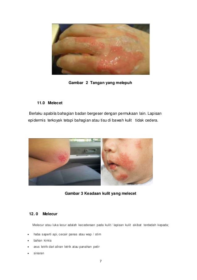 Assignment kecederaan kulit