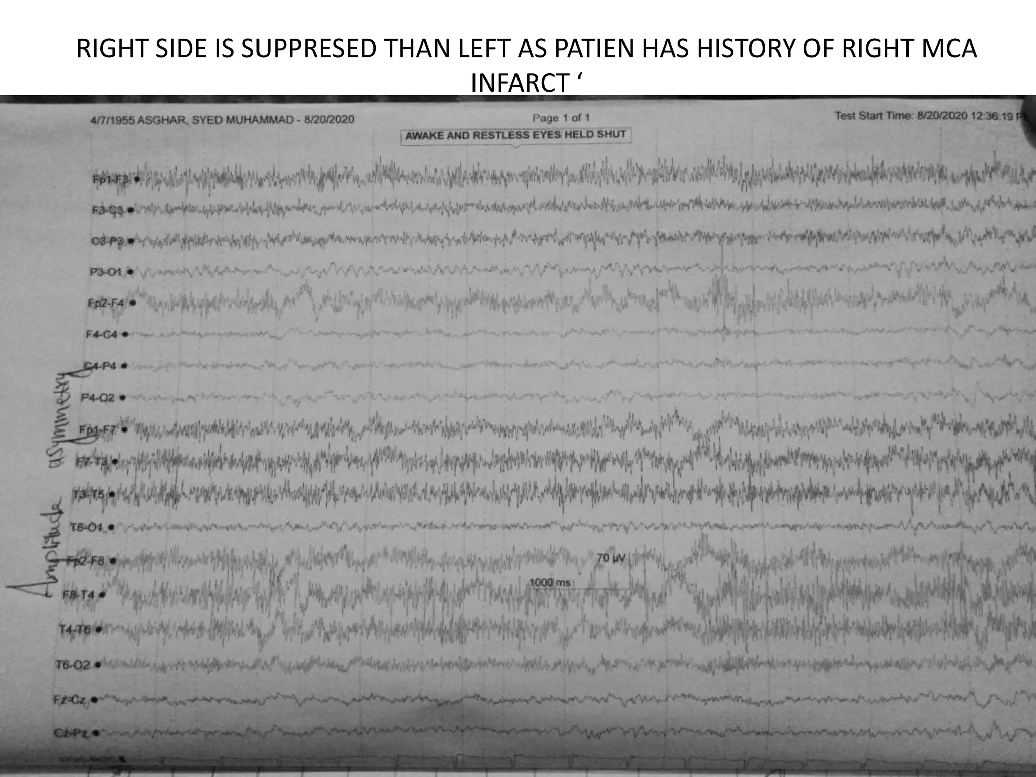 RIGHT SIDE IS SUPPRESED THAN LEFT AS PATIEN HAS HISTORY OF RIGHT MCA
INFARCT ‘
 