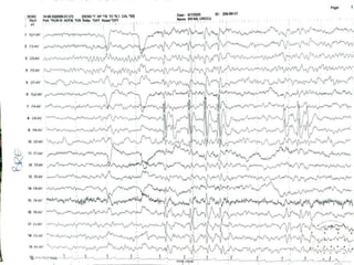 Abnormal EEG patterns | PPTX