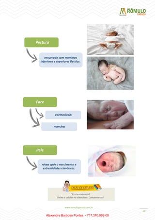 10
Postura
encurvado com membros
inferiores e superiores fletidos.
Face
edemaciada;
manchas
Pele
rósea após o nascimento e
extremidades cianóticas.
“Está estudando?
Deixe o celular no silencioso. Concentre-se!
Alexandre Barbosa Pontes - 717.370.062-00
 