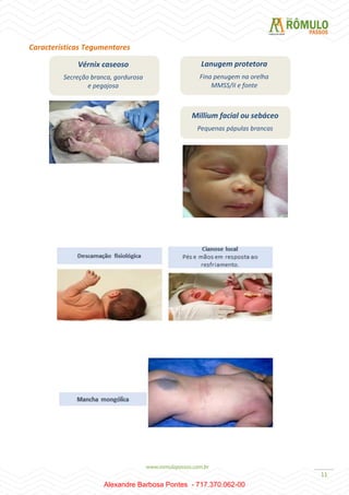 11
Características Tegumentares
Vérnix caseoso
Secreção branca, gordurosa
e pegajosa
Lanugem protetora
Fina penugem na orelha
MMSS/II e fonte
Millium facial ou sebáceo
Pequenas pápulas brancas
Alexandre Barbosa Pontes - 717.370.062-00
 