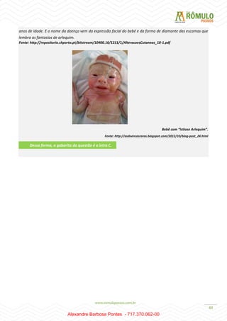 44
anos de idade. E o nome da doença vem da expressão facial do bebé e da forma de diamante das escamas que
lembra as fantasias de arlequim.
Fonte: http://repositorio.chporto.pt/bitstream/10400.16/1231/1/AlteracoesCutaneas_18-1.pdf
Bebê com “Ictiose Arlequim”.
Fonte: http://asdoencasraras.blogspot.com/2012/10/blog-post_24.html
Dessa forma, o gabarito da questão é a letra C.
Alexandre Barbosa Pontes - 717.370.062-00
 