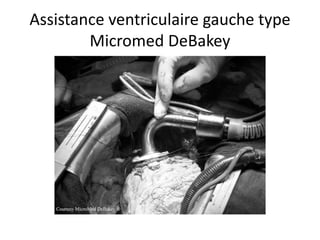 Assistance ventriculaire gauche type
Micromed DeBakey
 