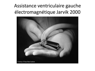 Assistance ventriculaire gauche
électromagnétique Jarvik 2000
 
