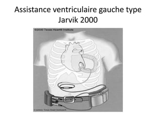 Assistance ventriculaire gauche type
Jarvik 2000
 