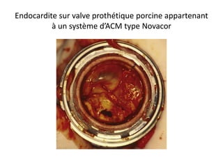Endocardite sur valve prothétique porcine appartenant
à un système d’ACM type Novacor
 
