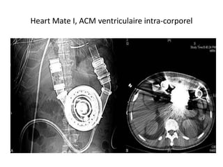 Heart Mate I, ACM ventriculaire intra-corporel
 
