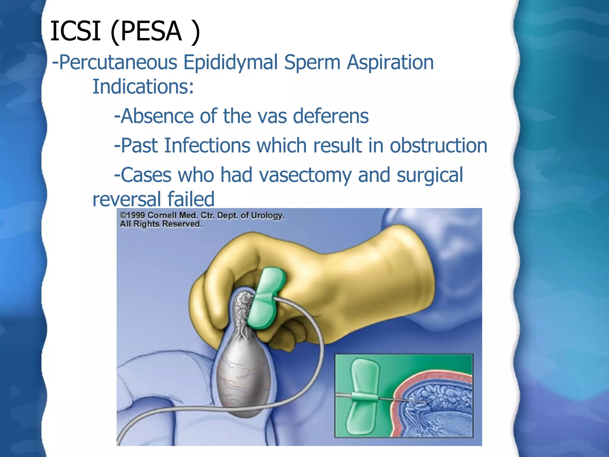 ICSI (PESA )   -Percutaneous Epididymal Sperm Aspiration Indications: -Absence of the vas deferens -Past Infections which result in obstruction -Cases who had vasectomy and surgical reversal failed 