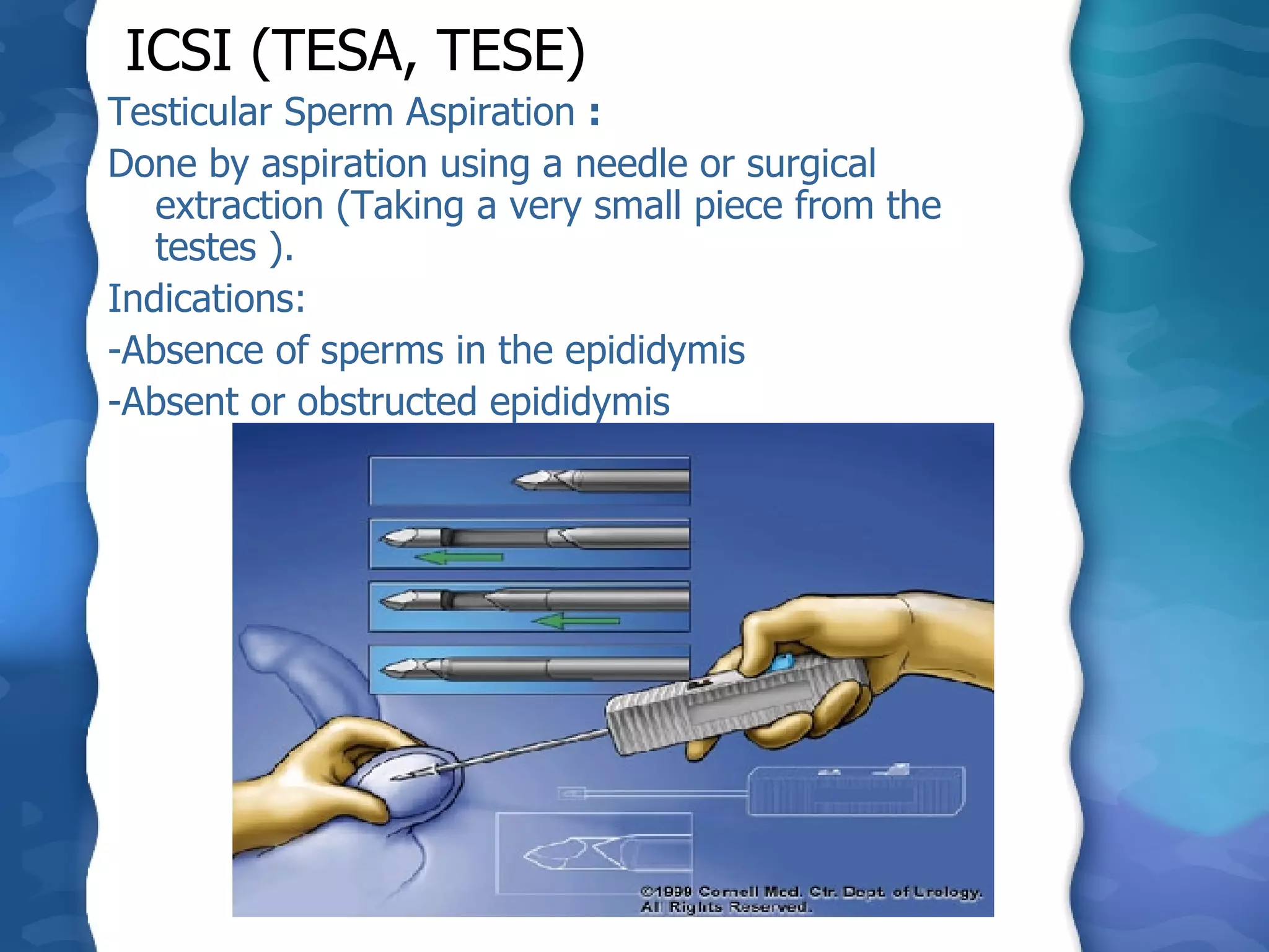 ICSI (TESA, TESE)   Testicular Sperm Aspiration  : Done by aspiration using a needle or surgical extraction (Taking a very small piece from the testes ).  Indications: -Absence of sperms in the epididymis -Absent or obstructed epididymis 