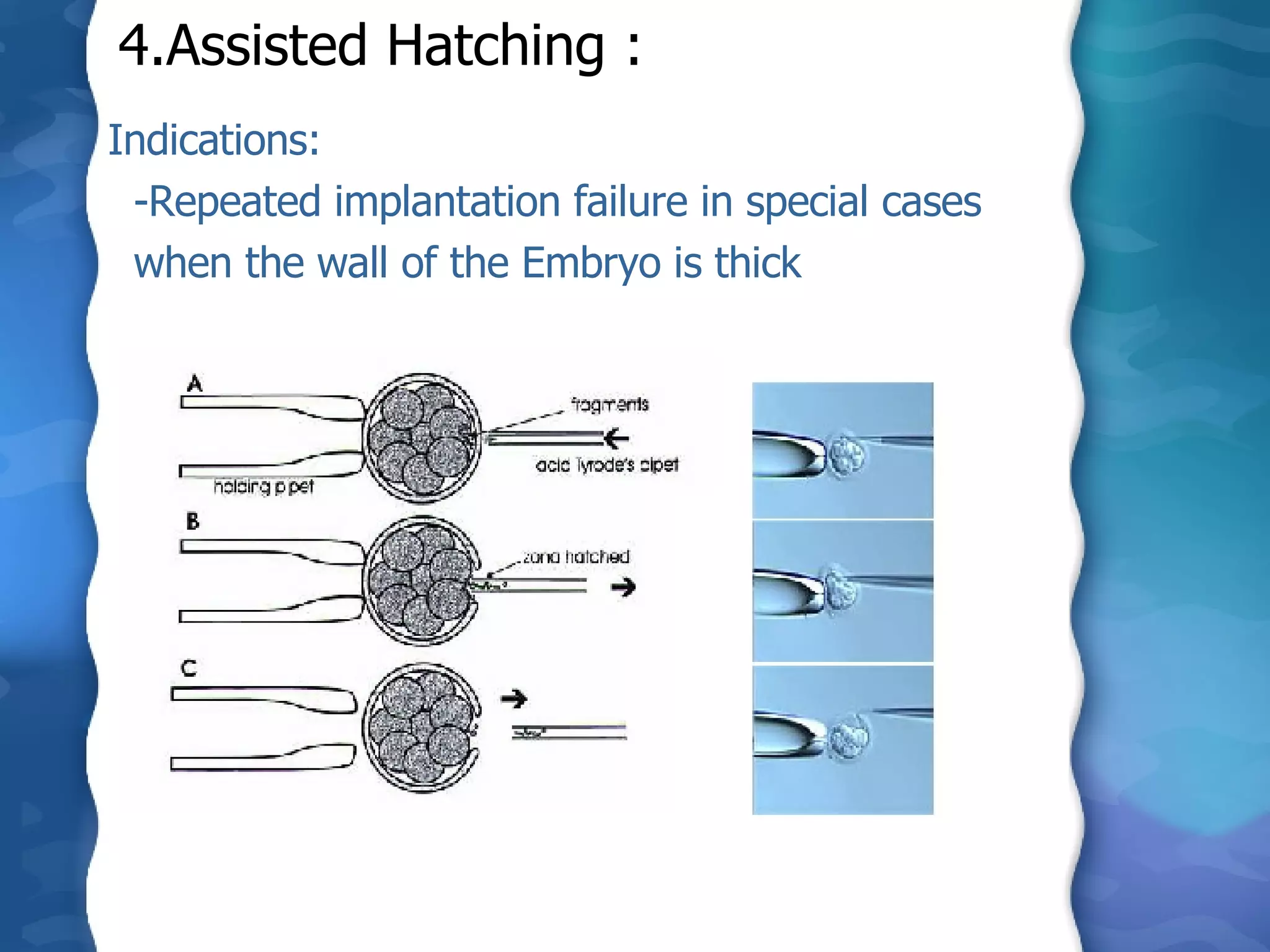 4.Assisted Hatching :   Indications: -Repeated implantation failure in special cases when the wall of the Embryo is thick 
