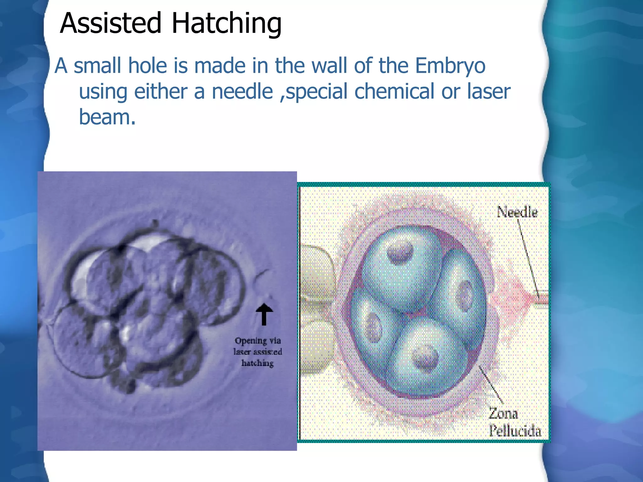 A small hole is made in the wall of the Embryo using either a needle ,special chemical or laser beam.  Assisted Hatching 