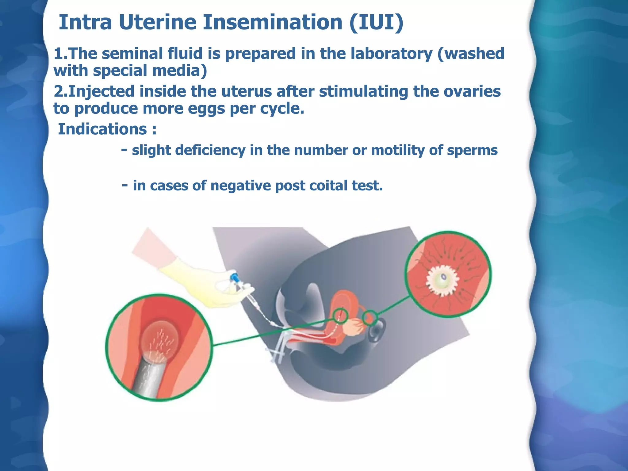 Intra Uterine Insemination (IUI)  1.The seminal fluid is prepared in the laboratory (washed with special media) 2.Injected inside the uterus after stimulating the ovaries to produce more eggs per cycle. Indications :    -  slight deficiency in the number or motility of sperms  -  in cases of negative post coital test. 