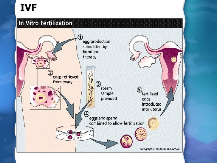 Assisted Reproductive Technology