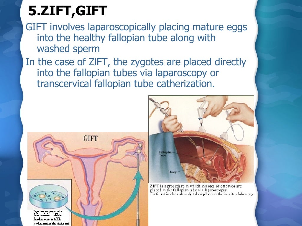 Assisted Reproductive Technology