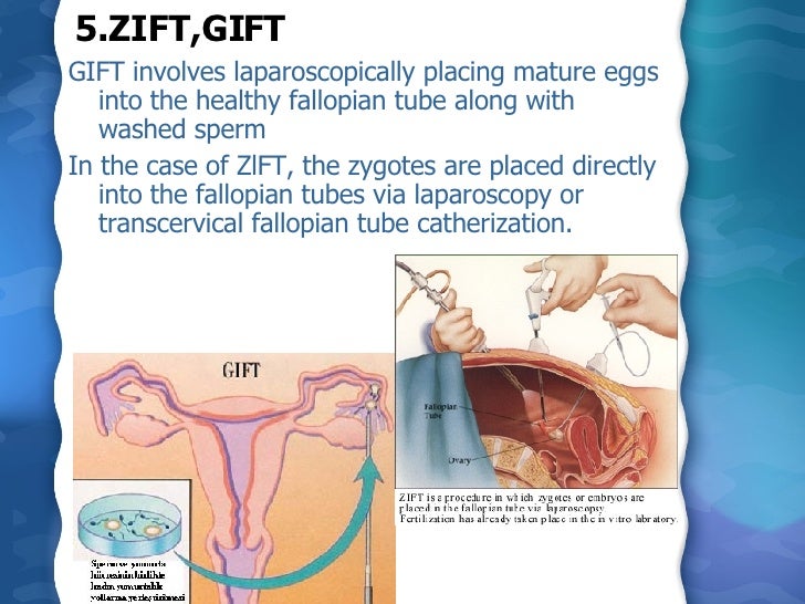 Assisted Reproductive Technology