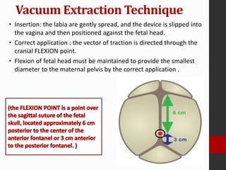 • Applying rotational force to rotate the head of the
fetus is contraindicated because it can lead to
detachment of the cu...