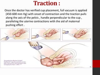 Maternal injury
• Vacuum extraction has a low rate of maternal injury in comparison
with forceps operations or cesarean de...