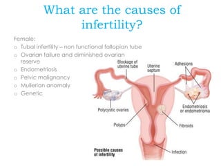 What are the causes of
infertility?
Female:
o Tubal infertility – non functional fallopian tube
o Ovarian failure and diminished ovarian
reserve
o Endometriosis
o Pelvic malignancy
o Mullerian anomaly
o Genetic
 