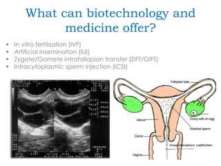 What can biotechnology and
medicine offer?
 In vitro fertilisation (IVF)
 Artificial insemination (IUI)
 Zygote/Gamete intrafallopian transfer (ZIFT/GIFT)
 Intracytoplasmic sperm injection (ICSI)
 
