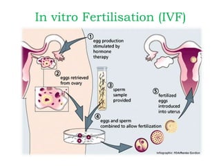 In vitro Fertilisation (IVF)
 