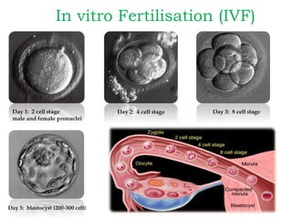 In vitro Fertilisation (IVF)
 