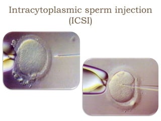 Intracytoplasmic sperm injection
(ICSI)
 