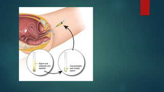 ASSISTED REPRODUCTIVE TECHNIQUES. presen