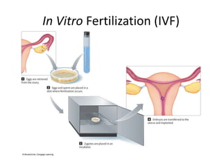 In Vitro Fertilization (IVF) 
 