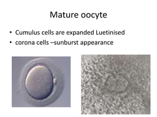 Mature oocyte 
• Cumulus cells are expanded Luetinised 
• corona cells –sunburst appearance 
 