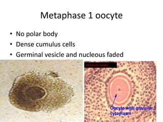 Metaphase 1 oocyte 
• No polar body 
• Dense cumulus cells 
• Germinal vesicle and nucleous faded 
Immature oocyte 
 