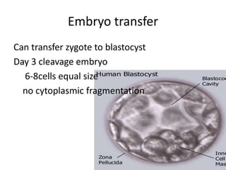 Embryo transfer 
Can transfer zygote to blastocyst 
Day 3 cleavage embryo 
6-8cells equal size 
no cytoplasmic fragmentation 
 