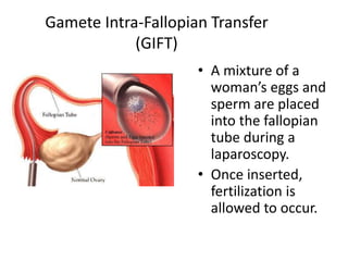 Gamete Intra-Fallopian Transfer 
(GIFT) 
• A mixture of a 
woman’s eggs and 
sperm are placed 
into the fallopian 
tube during a 
laparoscopy. 
• Once inserted, 
fertilization is 
allowed to occur. 
 