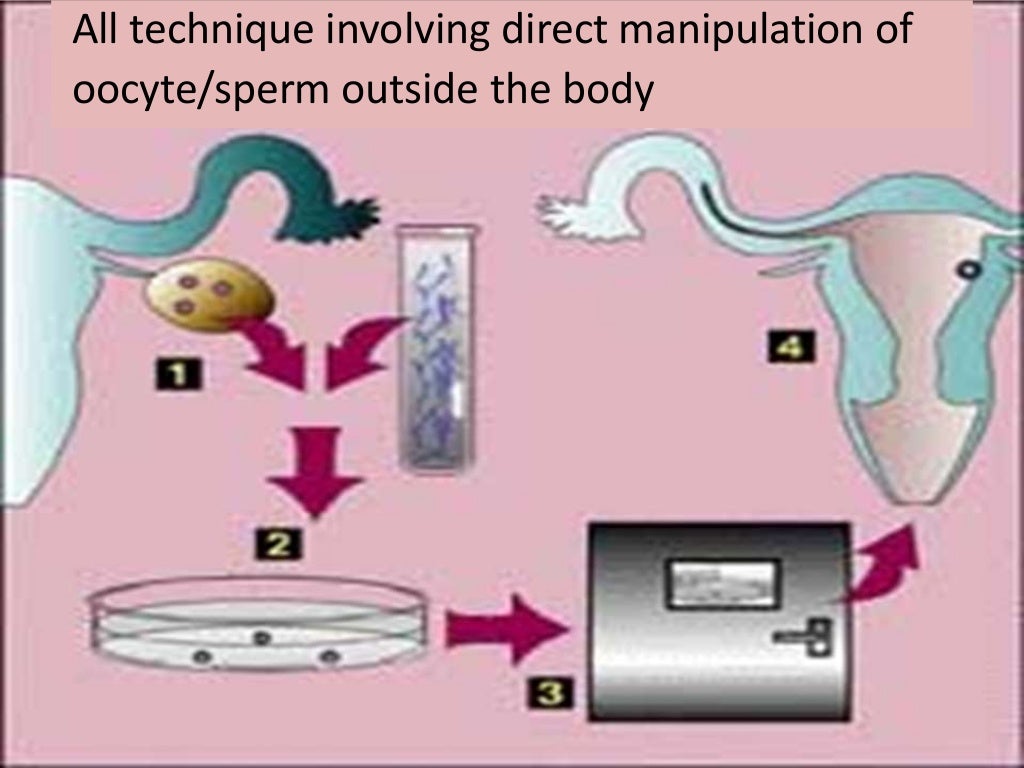 Assisted reproductive techniques