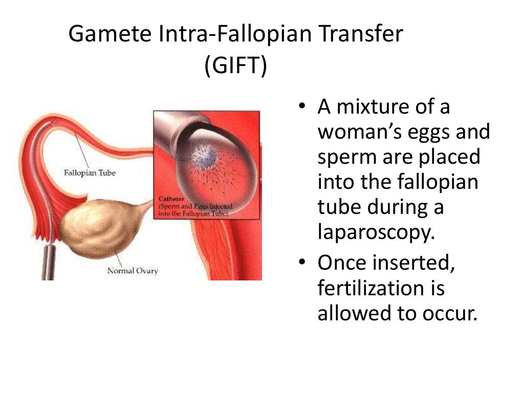 Assisted reproductive techniques