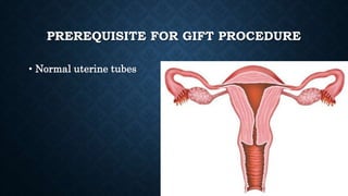 PREREQUISITE FOR GIFT PROCEDURE
• Normal uterine tubes
 