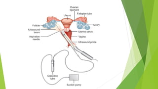 Assisted reproductive technology | PDF