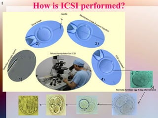 Assisted reproductive technology (ART) | PPT