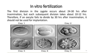 In vitro fertilization
The first division in the zygote occurs about 24-30 hrs after
insemination, but each subsequent division takes about 10-12 hrs.
Therefore, if an oocyte fails to divide by 30 hrs after insemination, it
should not be used for implantation.
14
 