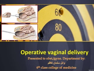 Operative vaginal delivery
 