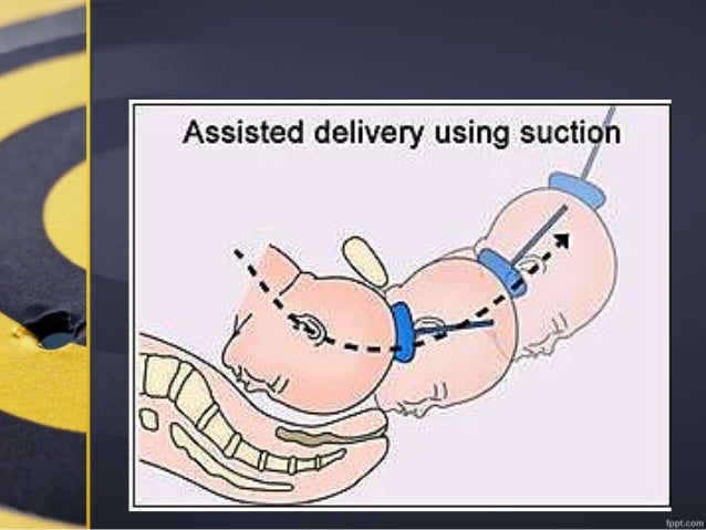 mio via Vaginal delivery Fisting sandra romain