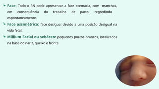  Face: Todo o RN pode apresentar a face edemacia, com manchas,
em consequência do trabalho de parto, regredindo
espontaneamente.
 Face assimétrica: face desigual devido a uma posição desigual na
vida fetal.
 Millium Facial ou sebáceo: pequenos pontos brancos, localizados
na base do nariz, queixo e fronte.
 