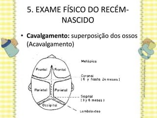 5. EXAME FÍSICO DO RECÉM-
NASCIDO
• Cavalgamento: superposição dos ossos
(Acavalgamento)
 