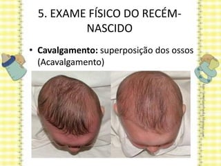 5. EXAME FÍSICO DO RECÉM-
NASCIDO
• Cavalgamento: superposição dos ossos
(Acavalgamento)
 