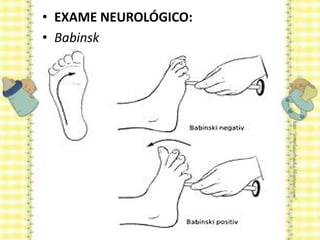 • EXAME NEUROLÓGICO:
• Babinsk
 